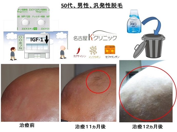 円形脱毛症　病院